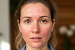 What Light Therapy Helps Rosacea?